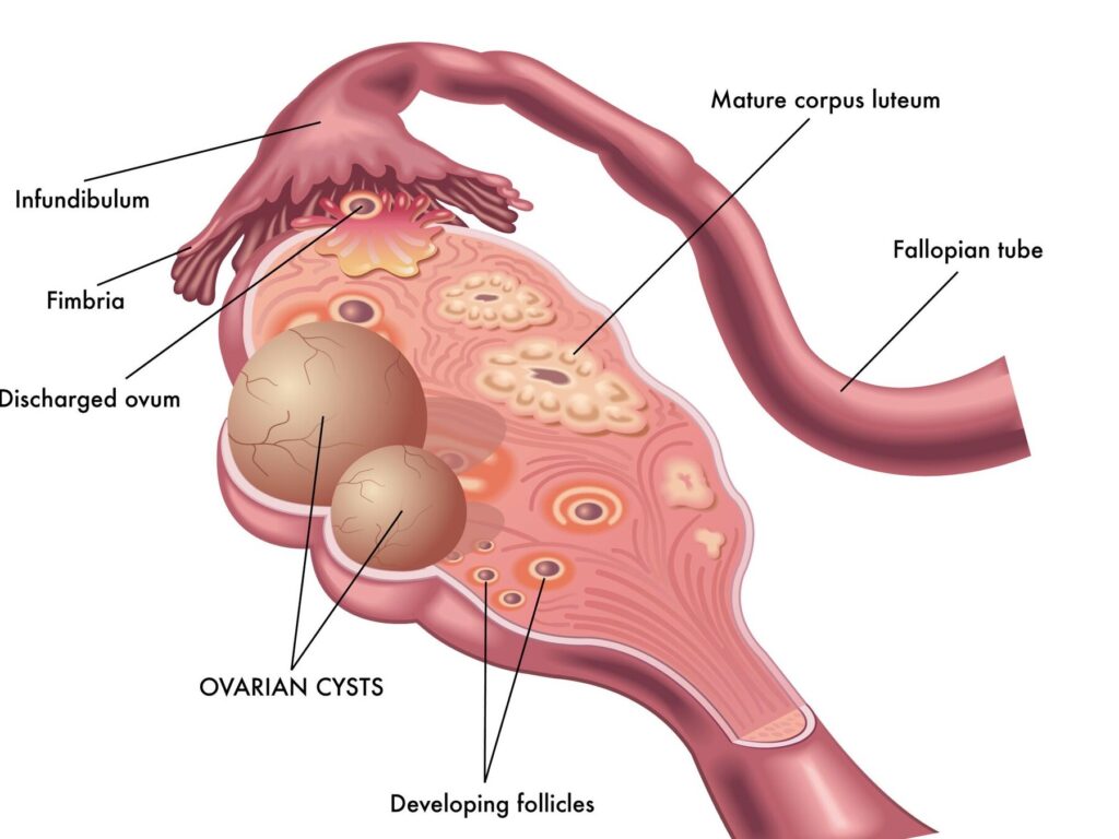 The Meaning of Cysts: Understanding the Causes and Implications The Meaning of Cysts: Understanding the Causes and Implications